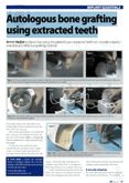 Autologous bone grafting using extraded teeth